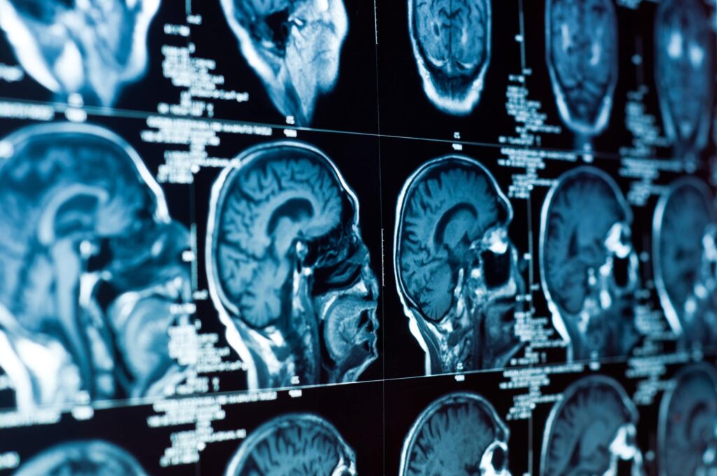 Minor Car Crashes Can Cause Major Brain Injuries