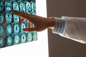 TBI, Memory Loss, and Your Legal Claim